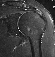 Supraspinatous Tendinosis MRI